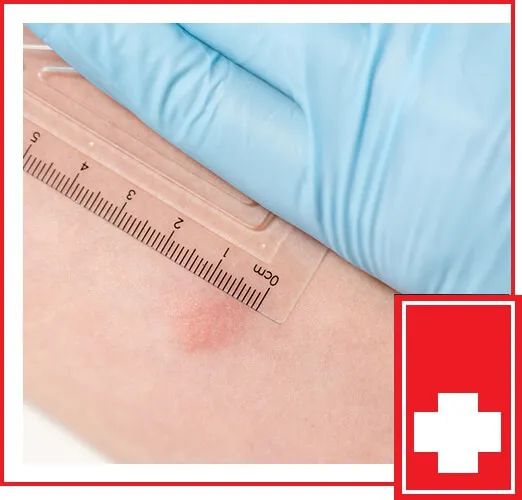 Positive Tuberculin Skin Test (TST) reaction measurement