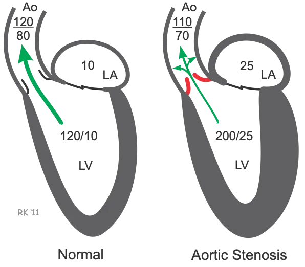 Normal vs. Aortic Stenosis Cardiac Cycle
