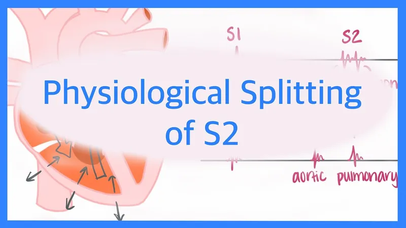 Physiological Splitting of S2