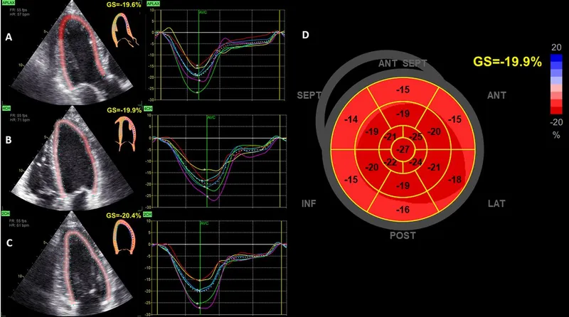 Speckle Tracking Echocardiography Global Longitudinal Strain