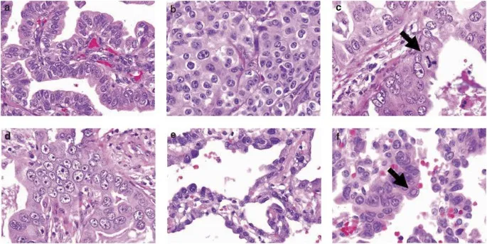 Cancer cells with nuclear atypia and mitotic figures