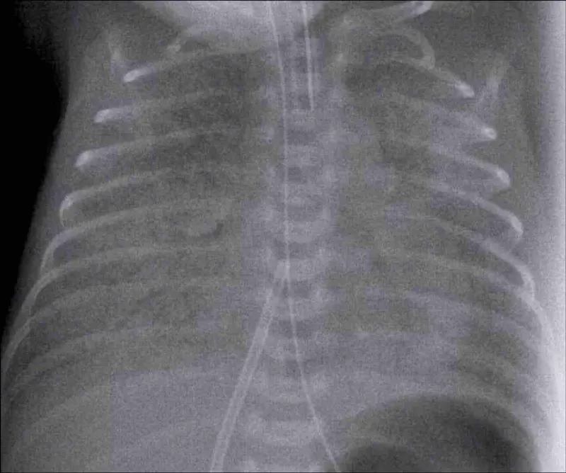 Chest X-ray: Neonatal Respiratory Distress Syndrome (NRDS)