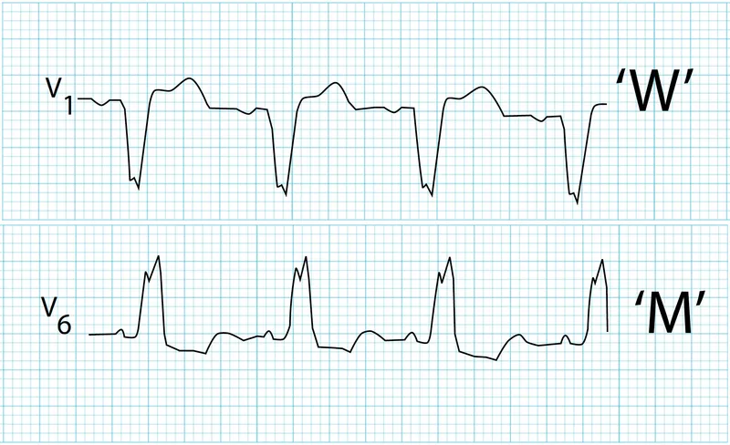 LBBB ECG: WiLLiaM pattern in V1 and V6