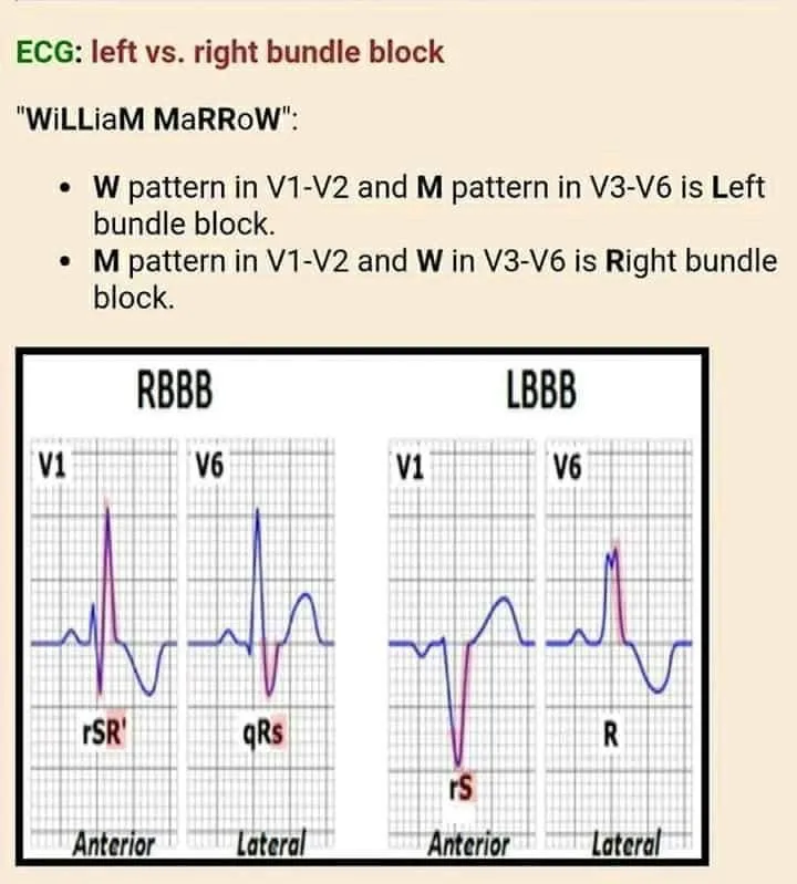 ECG patterns in Right and Left Bundle Branch Blocks