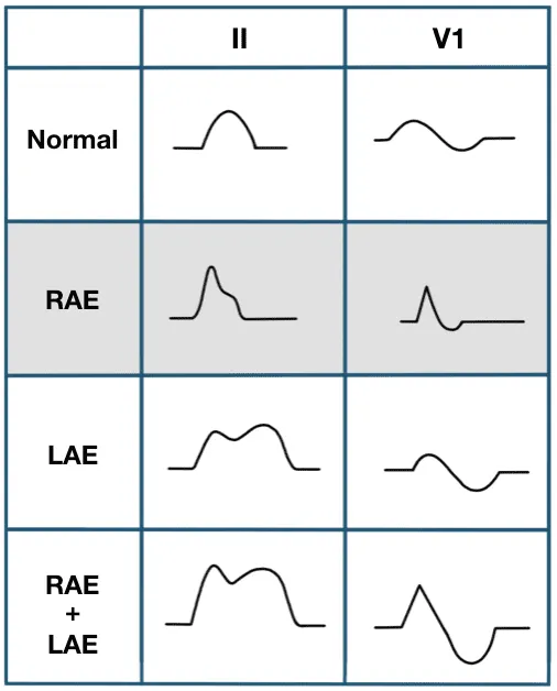 ECG P wave changes in atrial enlargement