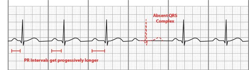 ECG: Second-degree AV block (Mobitz I/Wenckebach)