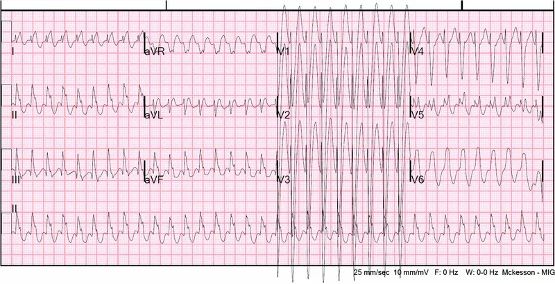 ECG: SVT converting to VT