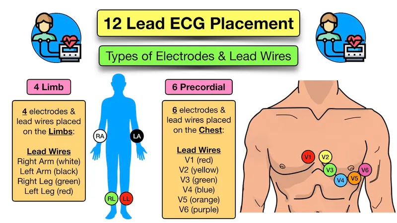 12-Lead ECG Electrode and Lead Wire Placement Diagram