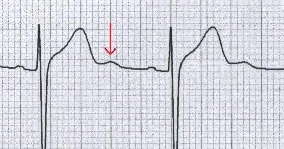 ECG showing prominent U waves in hypokalemia