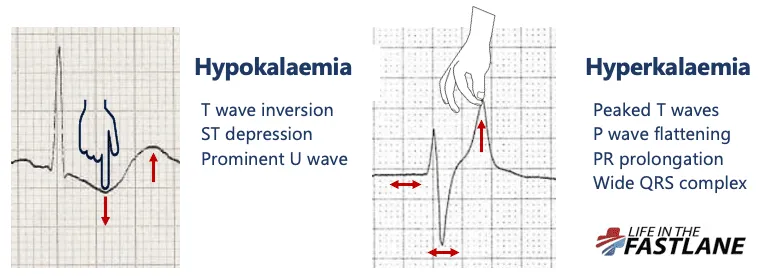 ECG changes in Hypokalemia vs. Hyperkalemia