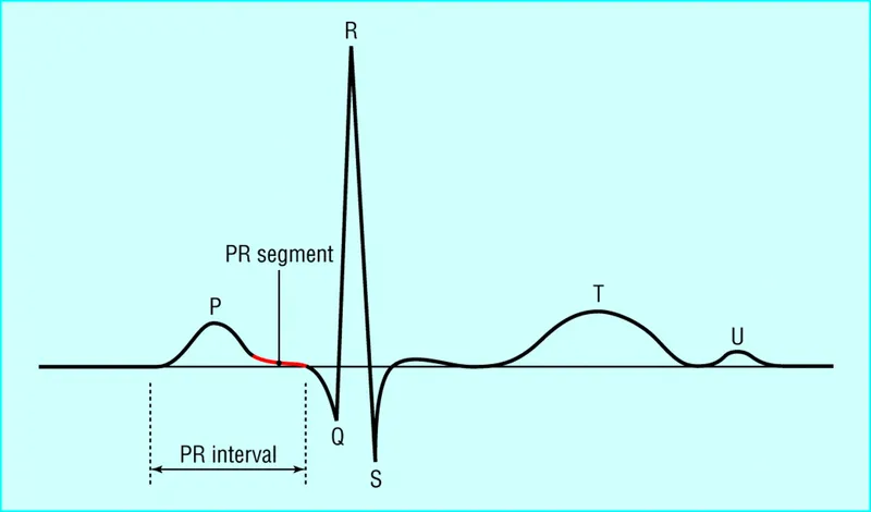 ECG Waveform with PR Interval and Segment Highlighted