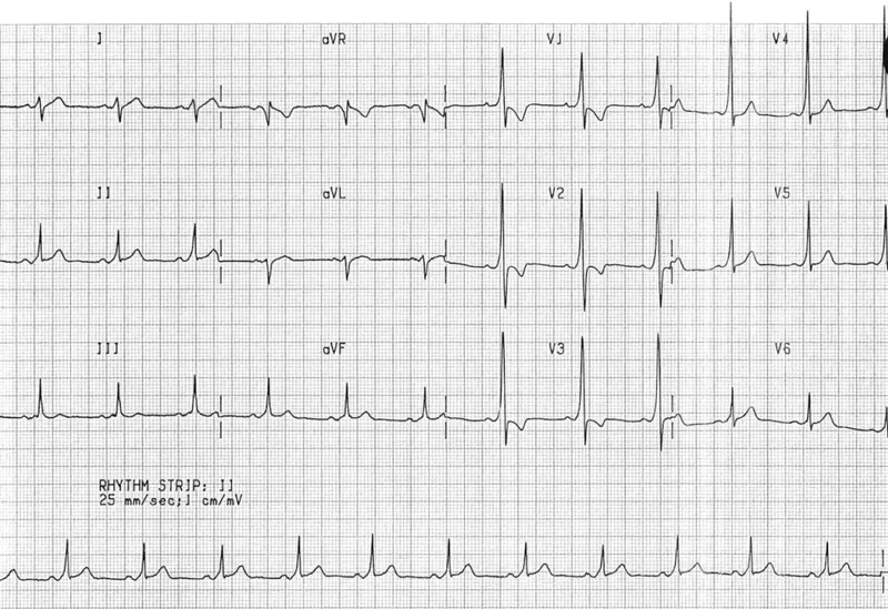 ECG: Wolff-Parkinson-White syndrome