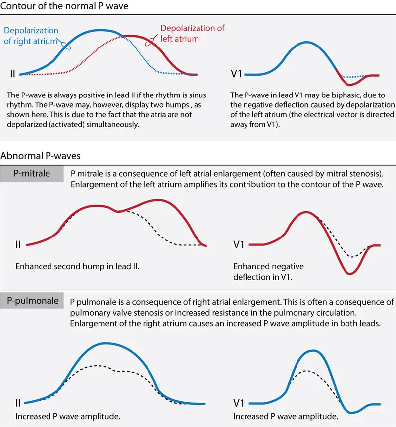 Normal and abnormal P-wave contours in ECG leads II and V1