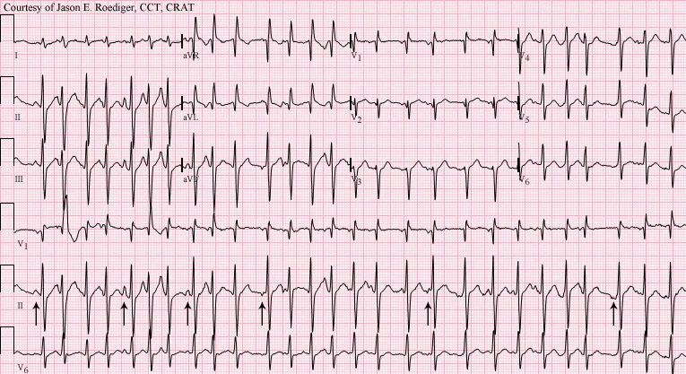 ECG: Multifocal Atrial Tachycardia with P wave variations