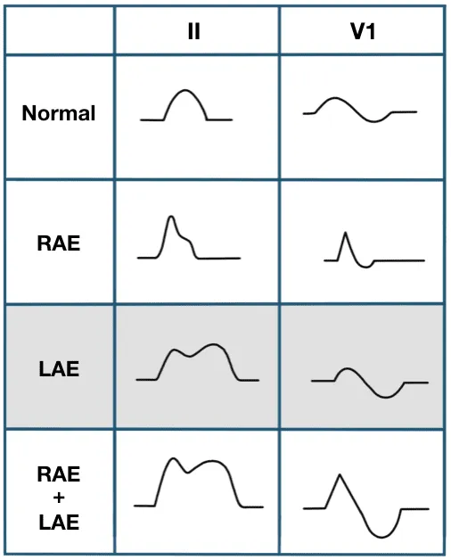 ECG P wave changes in atrial enlargement