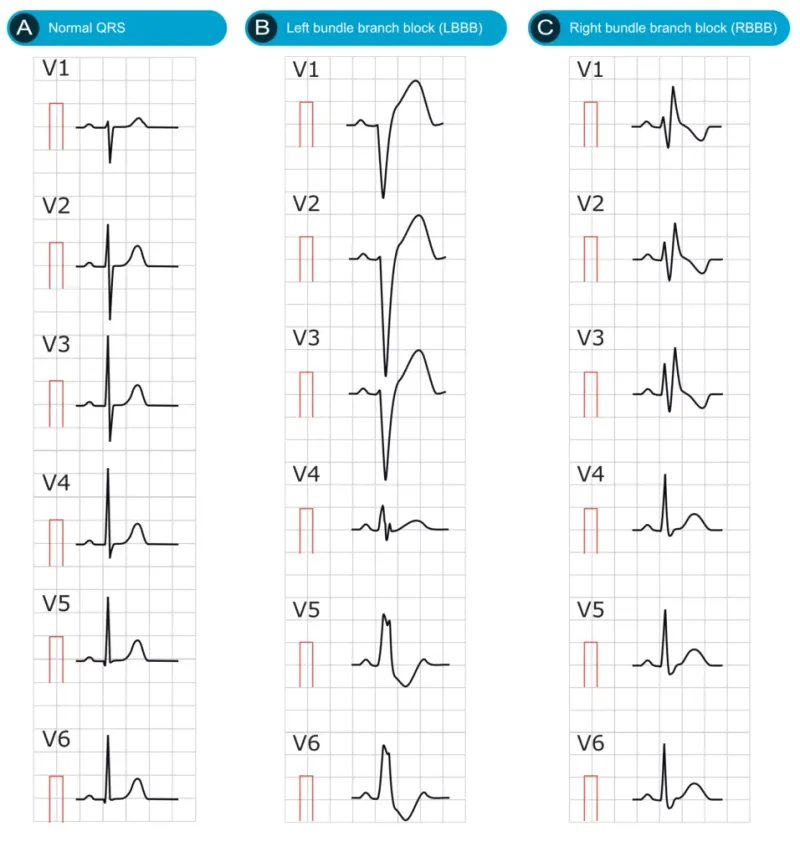 Normal vs. LBBB and RBBB QRS Complex Morphologies