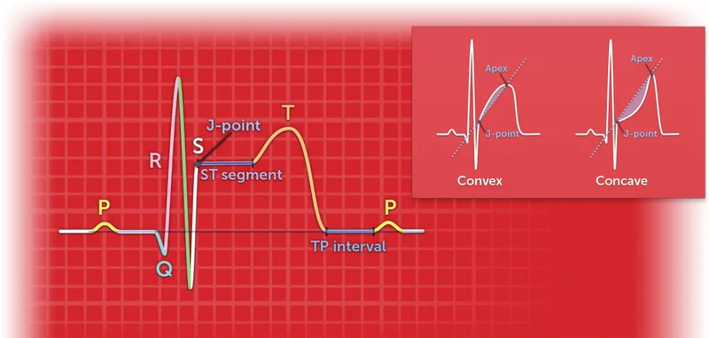 ECG: J-point, ST segment, and convex/concave morphologies
