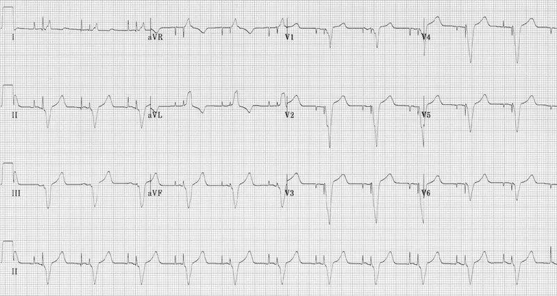 Tombstone ST elevation in V2-V4 ECG
