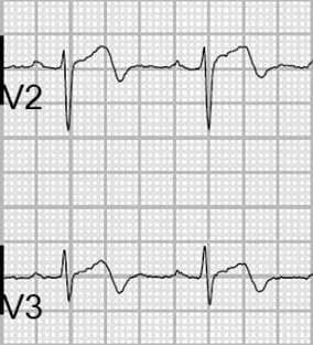 Wellens' Syndrome Type A: Biphasic T-waves in V2 and V3