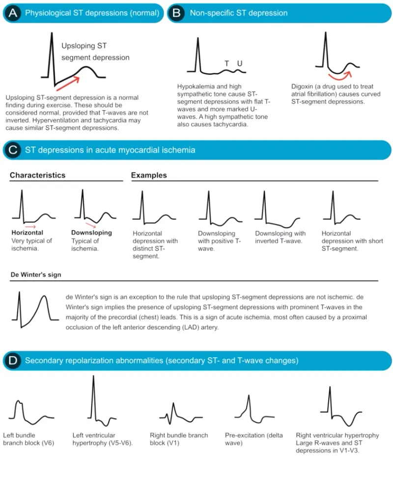ECG ST depression and T-wave changes in clinical conditions
