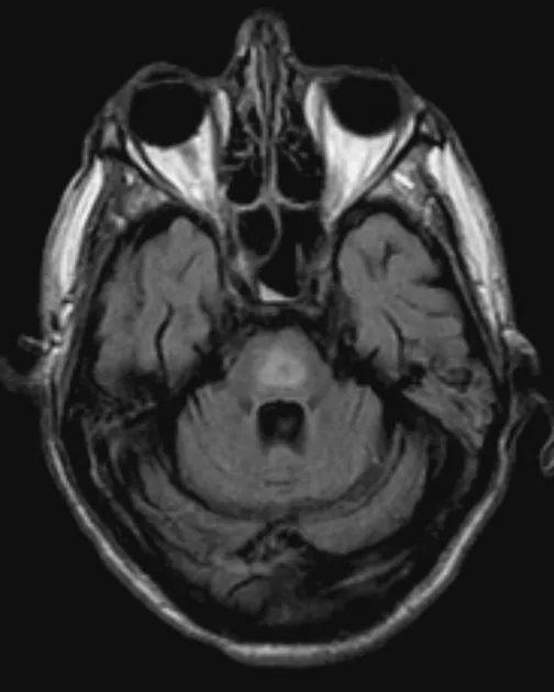 MRI: Central Pontine Myelinolysis