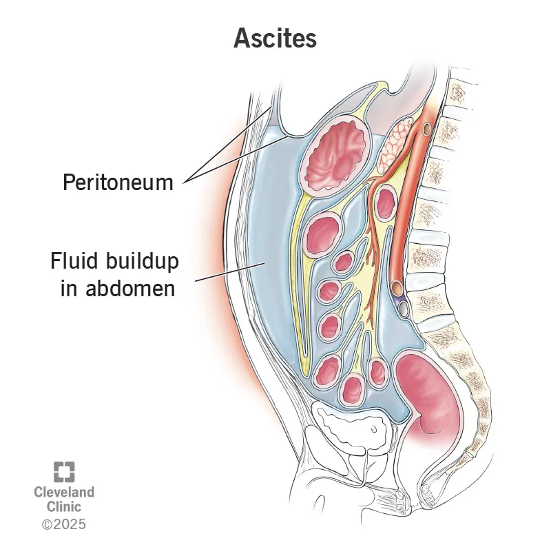 Ascites: Fluid Buildup in the Abdomen