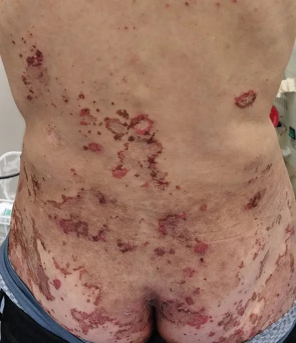 Necrolytic migratory erythema in glucagonoma