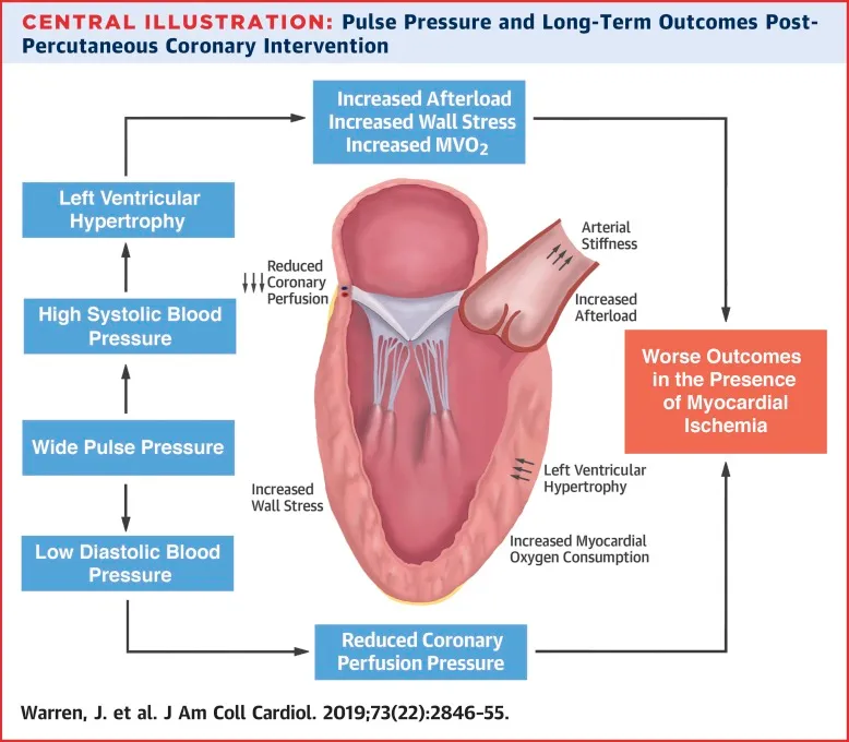 Pulse Pressure and Outcomes Post-Coronary Intervention