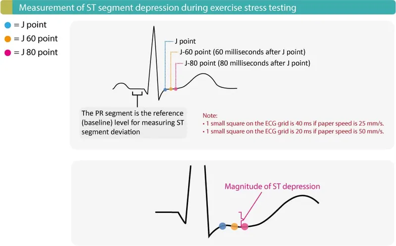 ECG: ST segment depression in exercise stress testing