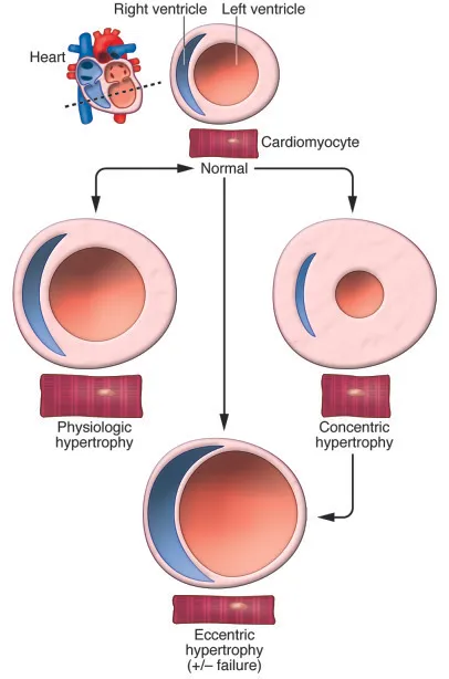 Cardiac hypertrophy: physiologic, concentric, and eccentric
