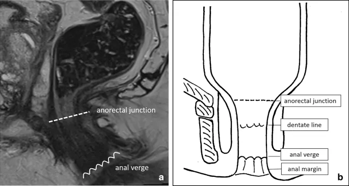 Anorectal anatomy: MRI and diagram