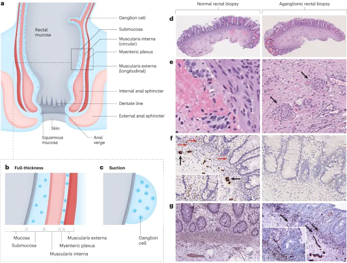 Rectal anatomy and histology in Hirschsprung disease