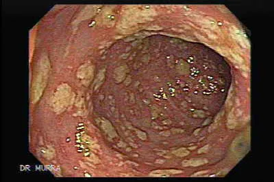 Endoscopic view of pseudomembranous colitis
