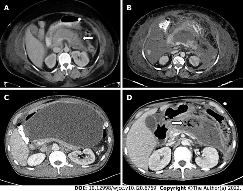 CT scans of acute pancreatitis complications