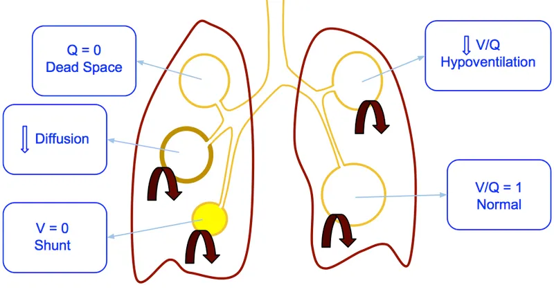 Causes of hypoxemia and their effect on V/Q ratio