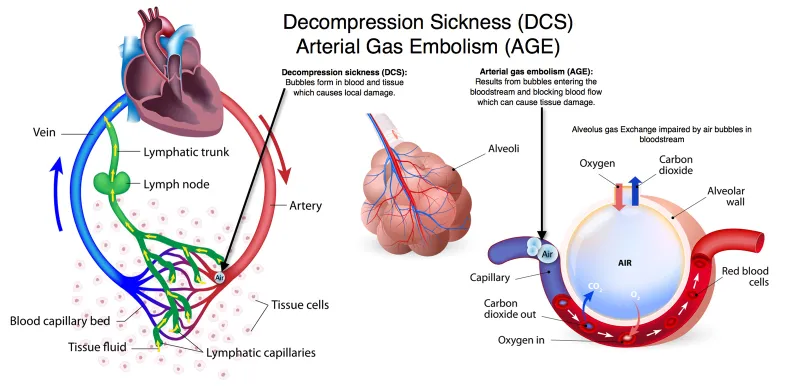 Decompression Sickness and Arterial Gas Embolism