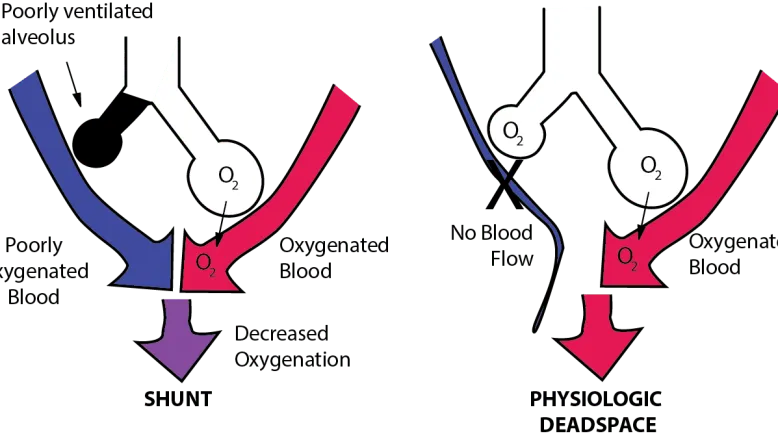 Shunt vs. Physiologic Dead Space in Lungs