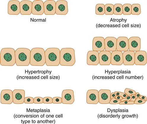 Cellular Adaptations: Atrophy, Hypertrophy, Hyperplasia