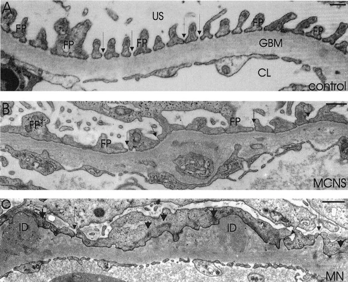 Podocyte effacement in minimal change disease vs. control
