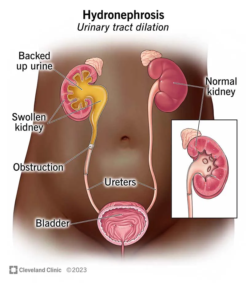 Hydronephrosis due to urinary tract obstruction
