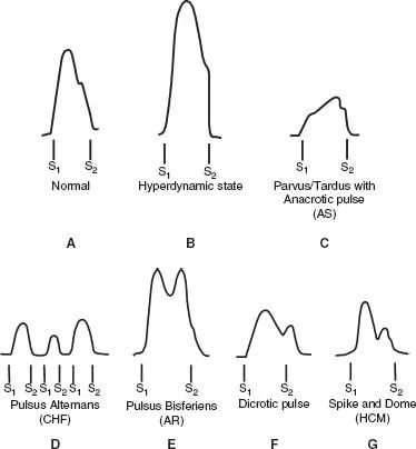 Arterial pressure waveforms: normal and pathological