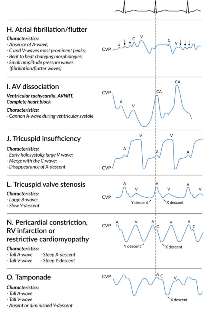 CVP Waveforms in Cardiac Conditions