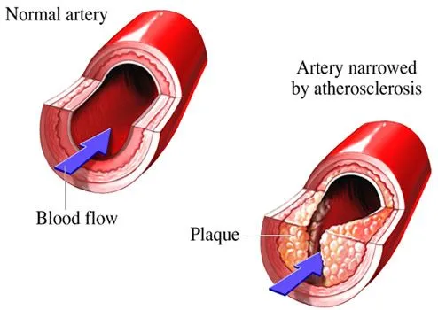 Atherosclerosis and blood flow reduction