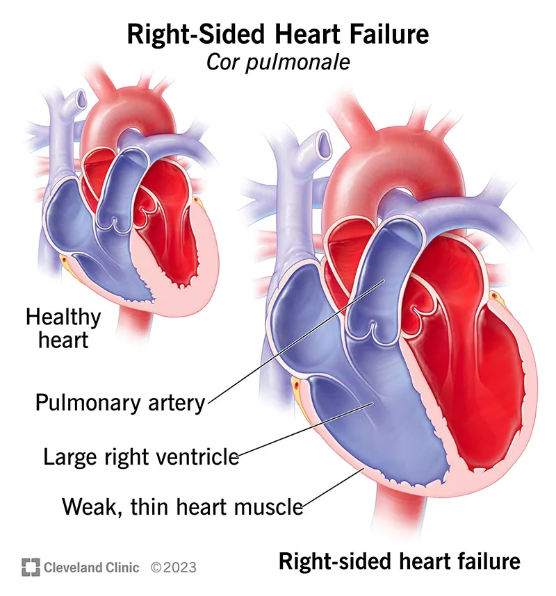 Cor Pulmonale: Healthy vs. Right-Sided Heart Failure