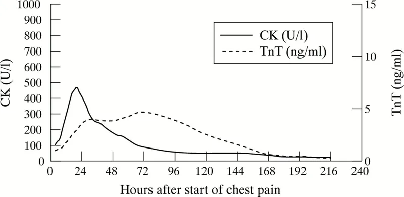 Cardiac Biomarker Time Course after MI
