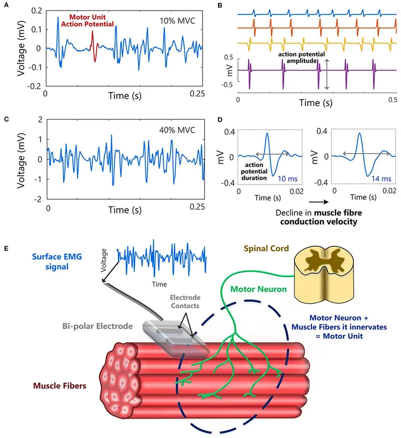 EMG setup, waveforms, and motor unit diagram
