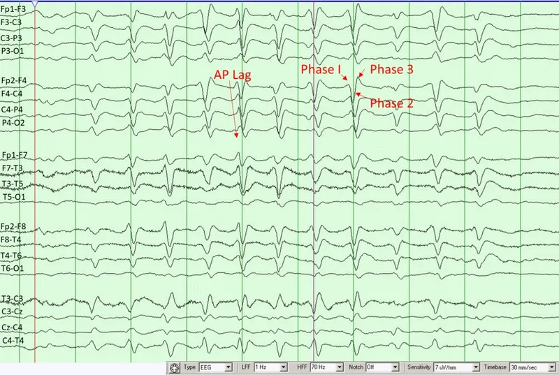 EEG: Triphasic waves in hepatic encephalopathy