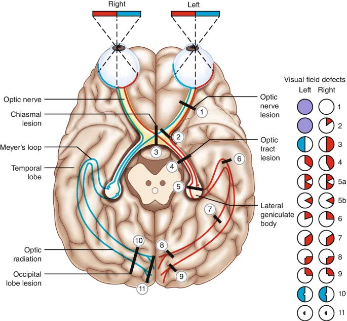 Visual pathway lesions and visual field defects
