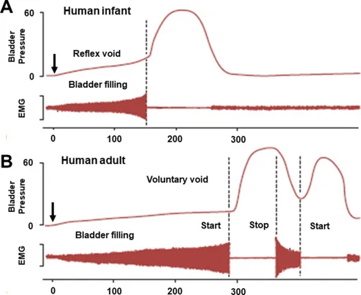 Cystometrogram: Infant reflex vs adult voluntary voiding