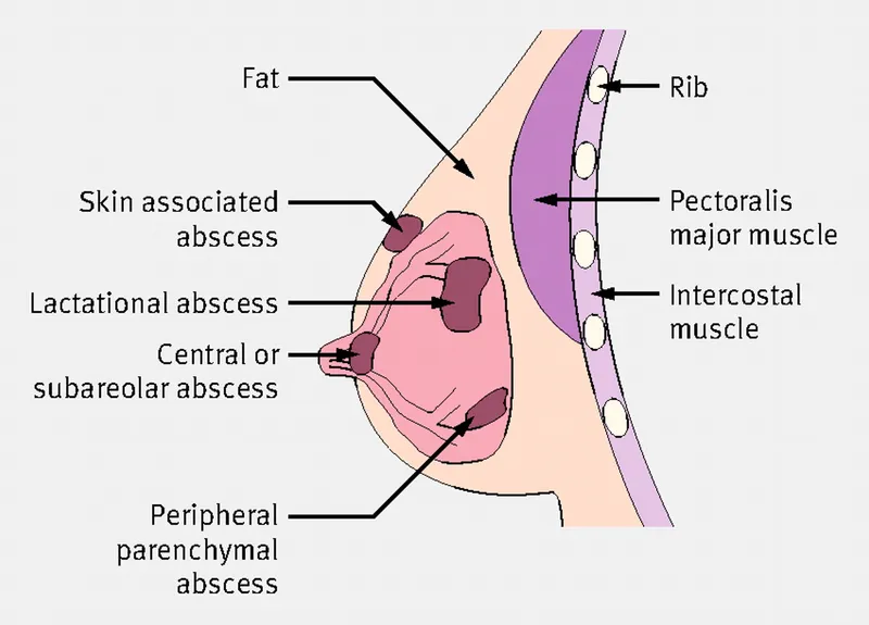 Types of Breast Abscesses